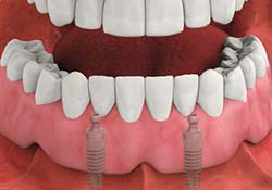 Dental implants provide a better solution for missing teeth than dentures