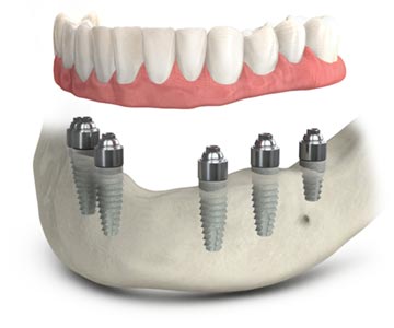 TeethXpress full-arch dental implants.