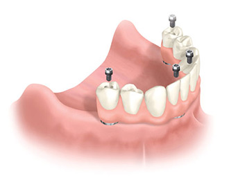 Dental Associates offers affordable dental implants to replace missing or failing teeth