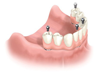 All-on-4 dental implants provide numerous benefits for replacing missing teeth