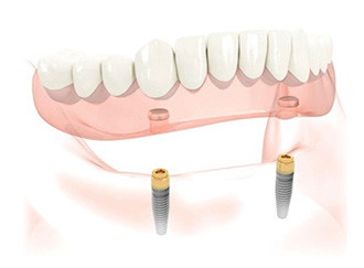 Implant-supported dentures stabilize a patient's existing dentures with dental implants