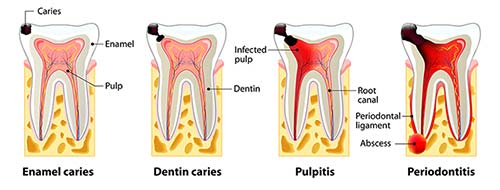 Root canal causes and the stage of caries development.