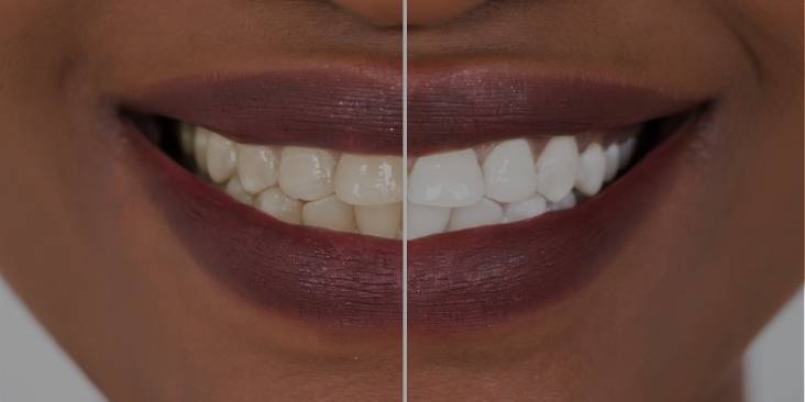 Professional vs. at-home teeth whitening.