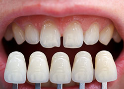 Dental veneers give stained or damaged teeth new life