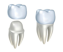 Dental crowns are placed on top of a damaged tooth to create a natural-looking replacement