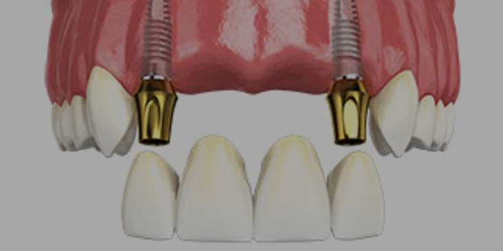 Dental implants for missing several teeth.