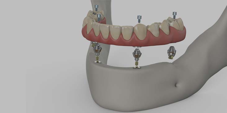 Dental implants for when you're missing all your teeth.
