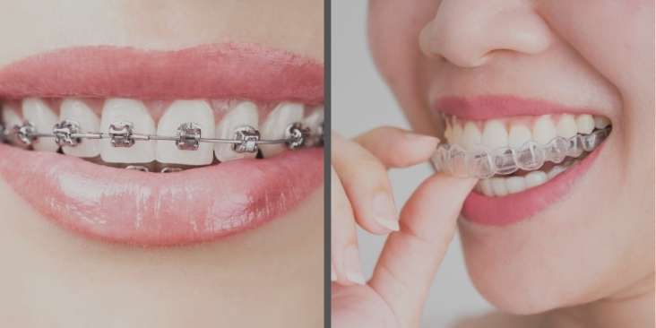 Learn the difference of Invisalign vs. braces.