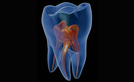 Learn about root canals.