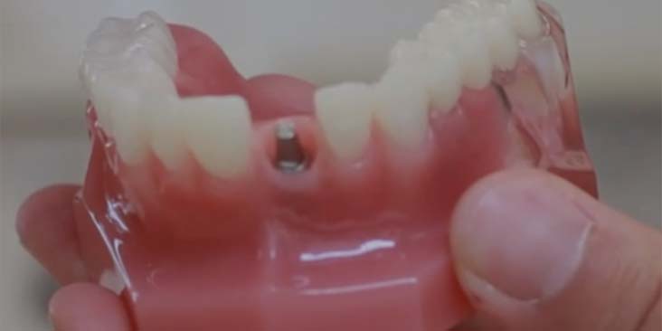 Dental Implant Question & Answer.