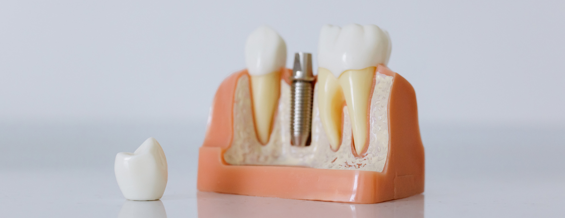 Three reasons to consider dental implants