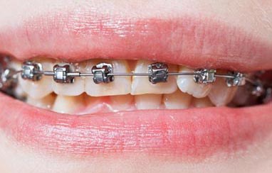 Braces correct misaligned bites