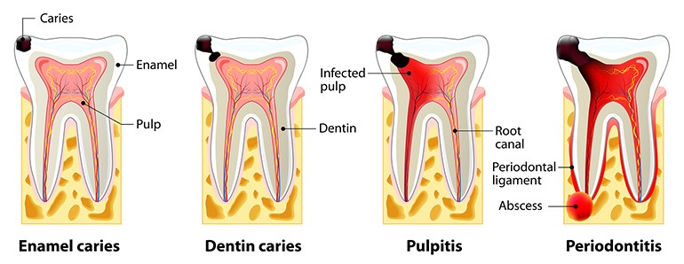 A root canal procedure relieves extreme tooth pain caused by a deep infection