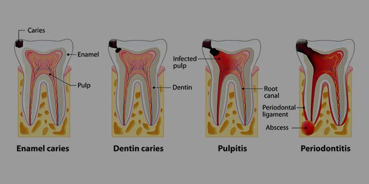 Root Canal causes.