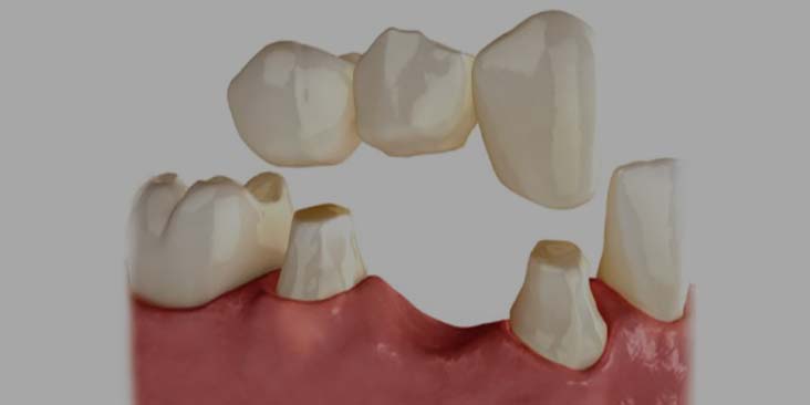 Learn about dental bridges.