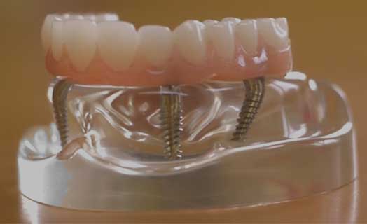 Dental implant procedures.