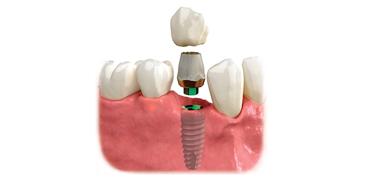 Dental Implants Cost