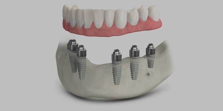 TeethXpress dental implants