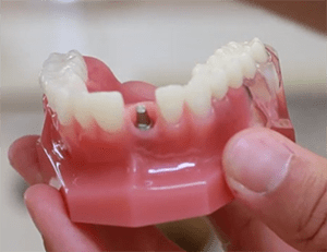 A single-tooth dental implant is secured into the jaw by an abutment