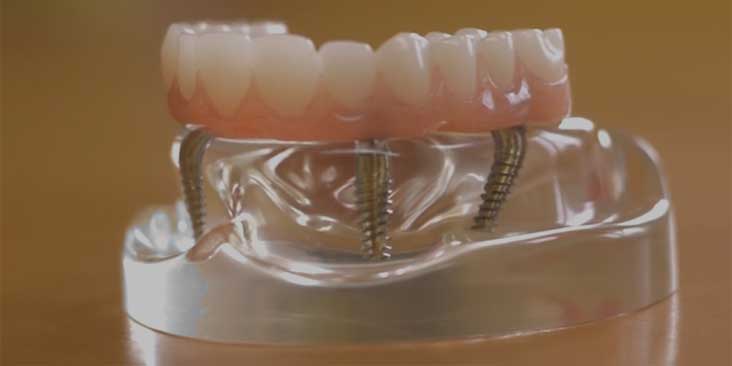 Dental implant procedures.