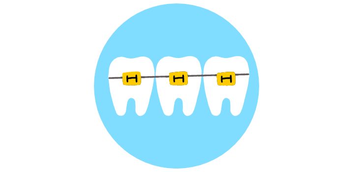 colored bands