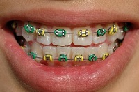 Traditional Braces