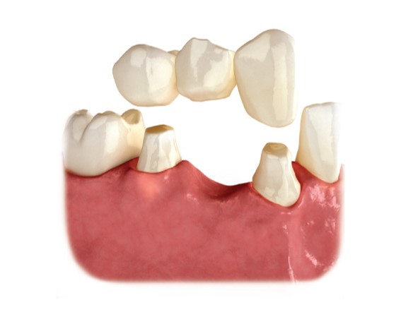 A dental bridge connects the gap where one or more teeth used to be