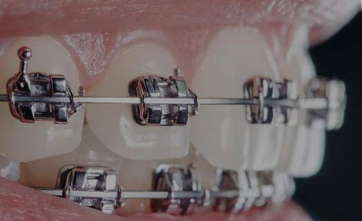 Learn about traditional braces with metal brackets.