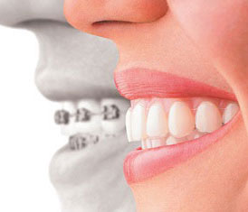 Invisalign clear aligners offer many advantages to traditional braces