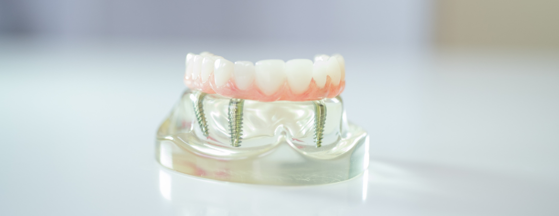 What Are Implant-Supported Dentures?