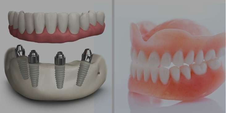 Dental implants vs. dentures.