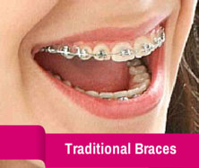 Waukesha traditional braces.