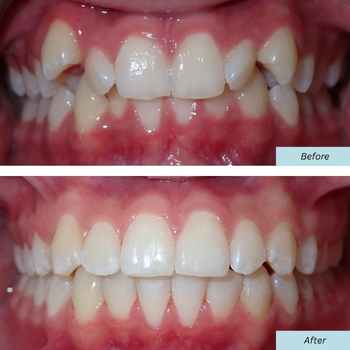 Patient Photo Before and After Orthodontic Braces