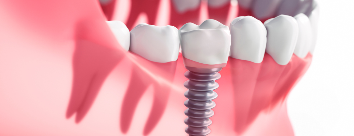 Dental implants cost