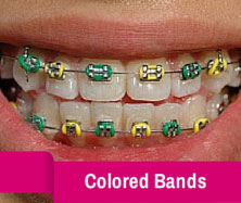 Waukesha braces with colored bands.