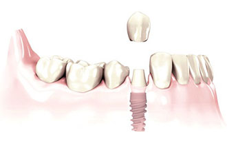 A single-tooth implant replaces a missing tooth and preserves the bone integrity to prevent further deterioration. 