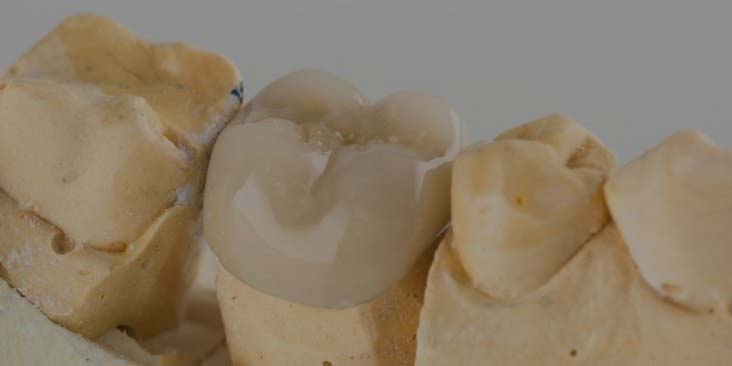 Learn about dental crowns.