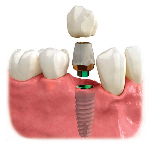 A single-tooth dental implant replaces a missing or failing tooth to restore stability and functionality