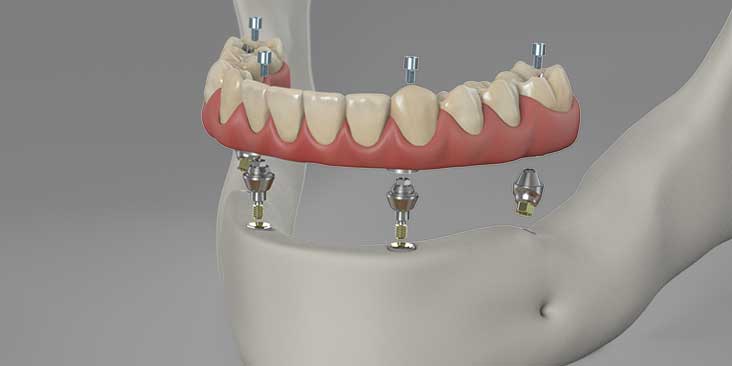 Dental Associates offers a full line of Dental Implants, from single tooth to full-arch replacement.