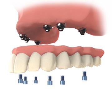TeethXpress Dental Implants benefits include replacing missing or failing teeth with fully-functioning replacement teeth