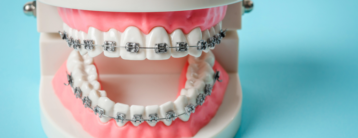 Braces do more than just straighten teeth