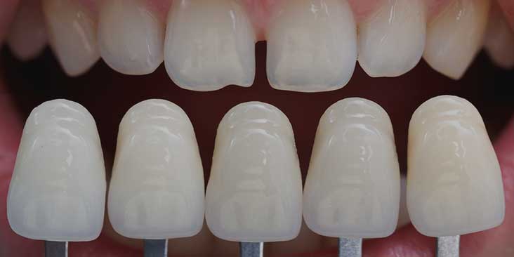 Learn about dental veneers.
