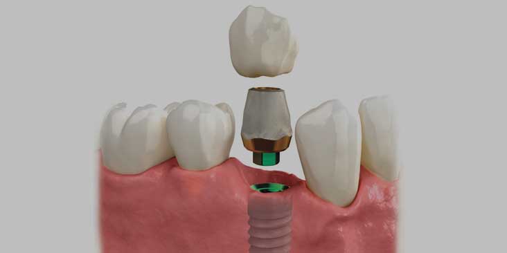 Dental implant for missing one tooth.