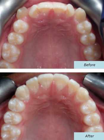 Patient Photo Before and After Orthodontic Braces