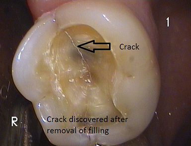 Chipped Molar Pain Chipped Molar Pain