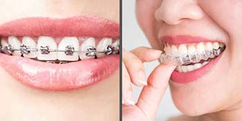 Invisalign vs traditional braces.