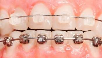 Clear braces brackets