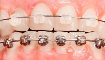 Clear Invisible Braces for Adults to Straighten Teeth