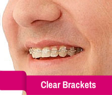 Waukesha clear braces.