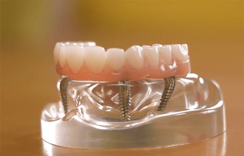 Replace all your missing teeth with dental implants to restore your mouth to full functionality